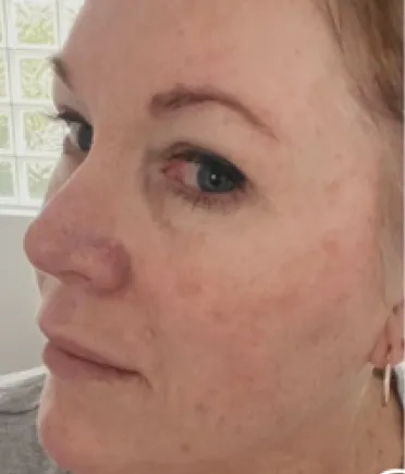 woman cheek with acne